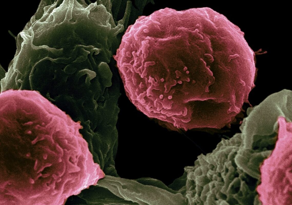 Causas de la Bartolinitis y Consecuencias de Tenerla