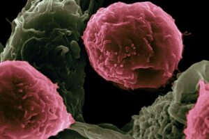 Causas de la Bartolinitis y Consecuencias de Tenerla