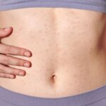 ERITEMA » Definición, Diagnóstico, Causas y Tratamiento Eritema Multiforme o Poliforme: Causas y Diagnóstico