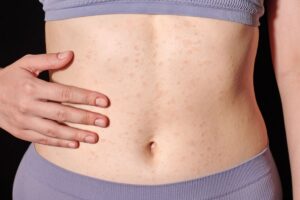 Eritema Multiforme o Poliforme: Causas y Diagnóstico