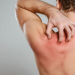 ERITEMA » Definición, Diagnóstico, Causas y Tratamiento Síntomas del Eritema: Diagnóstico y formas de Controlarlo