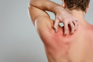 Síntomas del Eritema: Diagnóstico y formas de Controlarlo