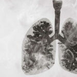 ¿El derrame pleural es peligroso? Trastornos y Reacción