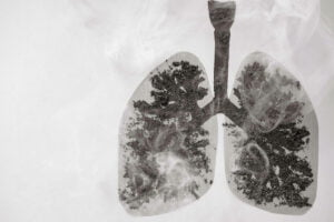 ¿El derrame pleural es peligroso? Trastornos y Reacción