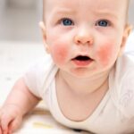 ERITEMA » Definición, Diagnóstico, Causas y Tratamiento Tipos de Eritema: Características, Reacciones y Síntomas