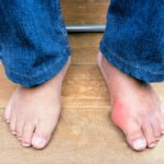 JUANETES » Causas, Síntomas y Complicaciones Tipos de juanetes: Síntomas y por qué salen