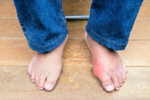 Tipos de juanetes: Síntomas y por qué salen