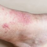 ERITEMA » Definición, Diagnóstico, Causas y Tratamiento Eritema Nodoso