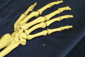 DIFERENCIA ENTRE ARTRITIS Y ARTRALGIA