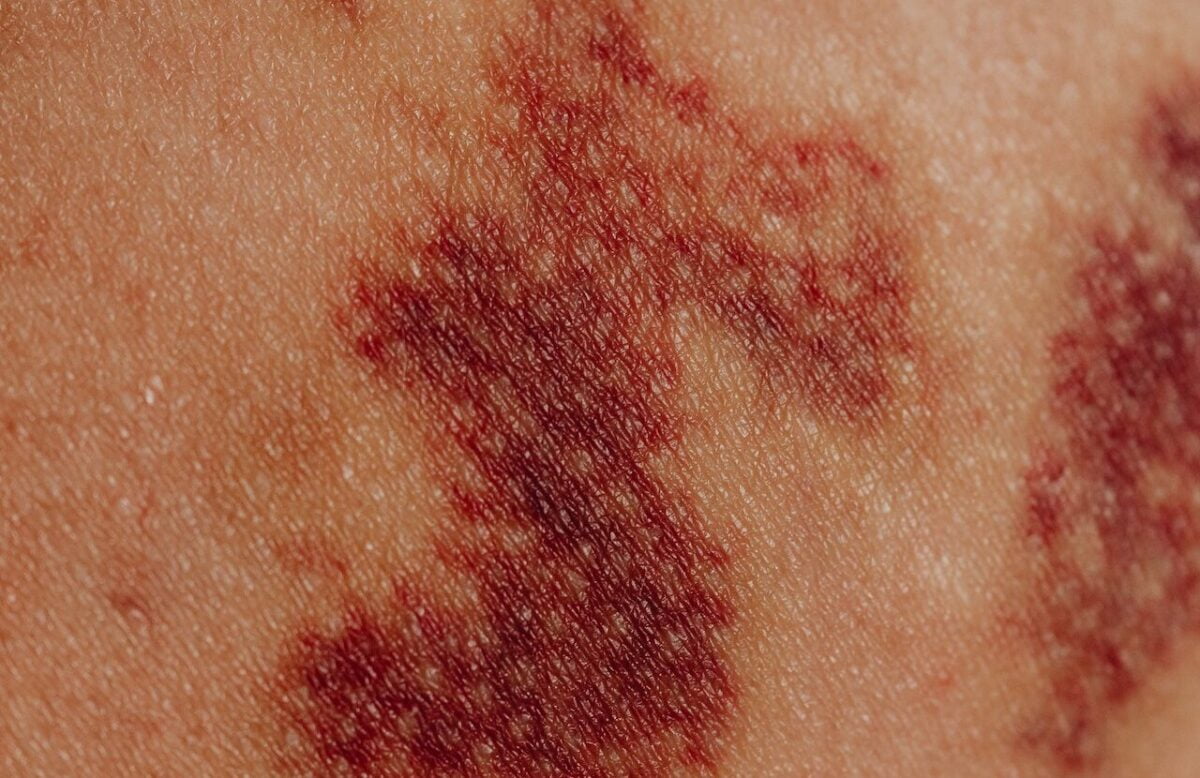 Tipos de Liquen Plano: Tratamiento y formas de reconocerlos