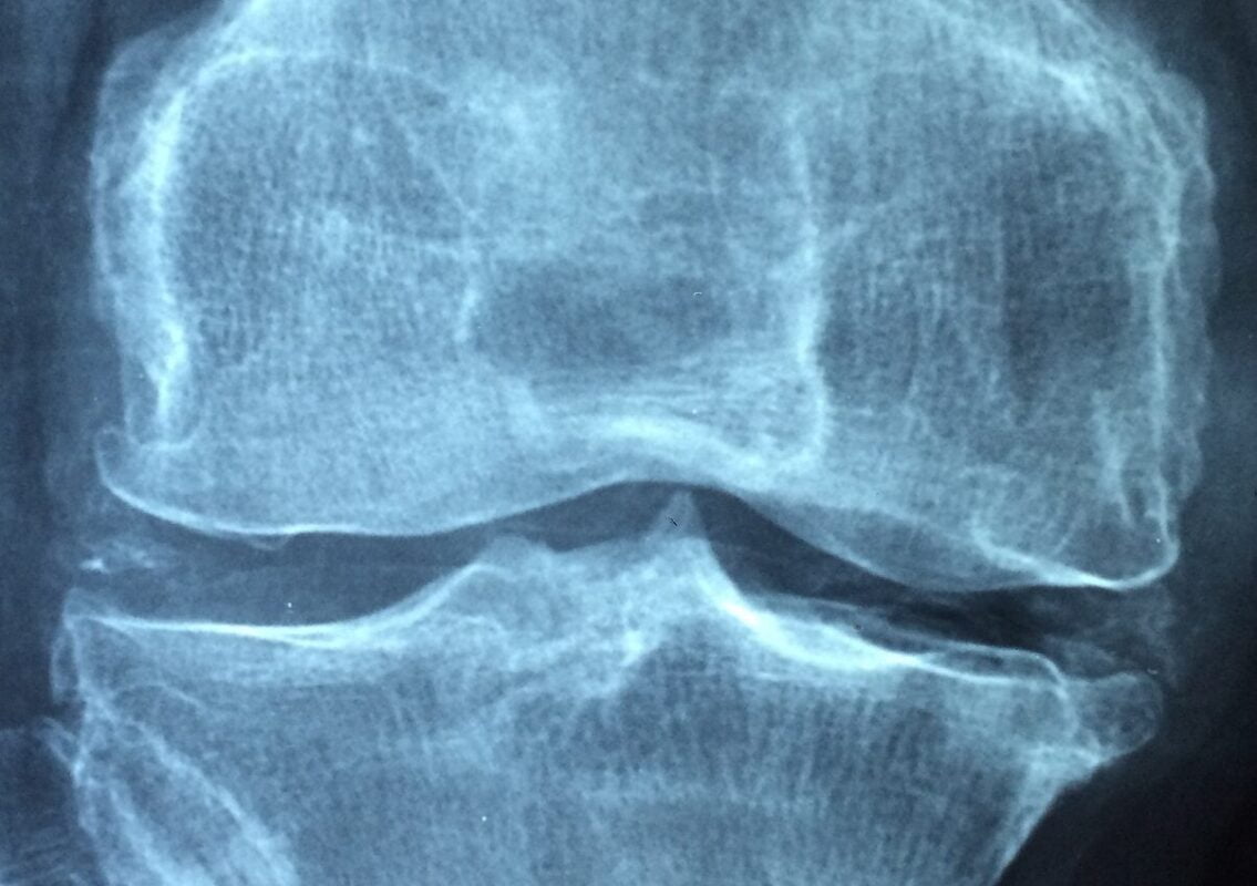 Tipos de Artralgia: Osteoartritis e Inflamatoria