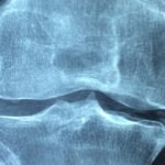 Tipos de Artralgia: Osteoartritis e Inflamatoria