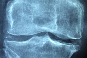 Tipos de Artralgia: Osteoartritis e Inflamatoria