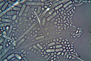 Eosinopenia: causas, tratamiento y recomendaciones