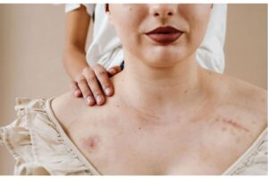 ÁCIDO SULFHÍDRICO EN CONTACTO CON LA PIEL