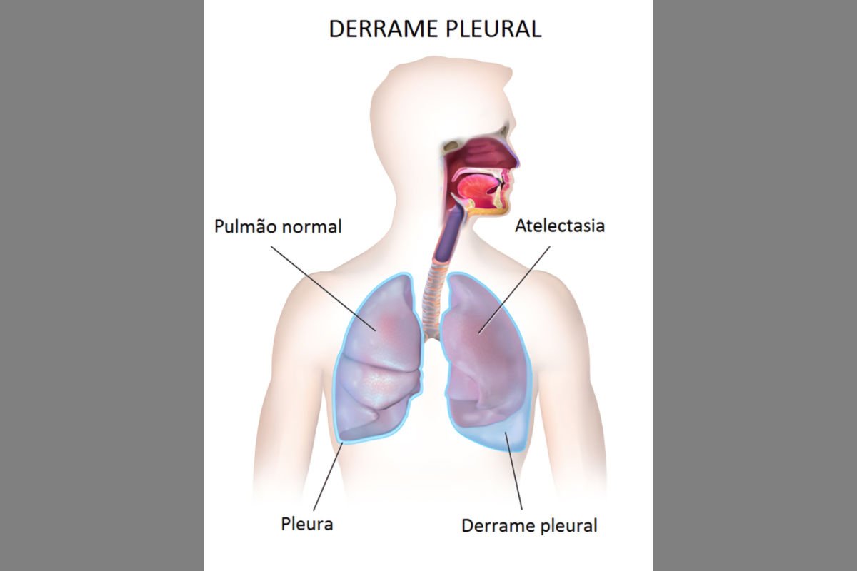 Consecuencias del derrame pleural