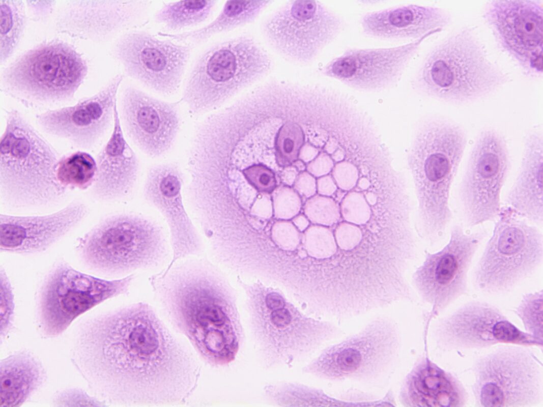 Neoplasia maligna y neoplasia benigna, ¿qué significan?. Foto por National Cancer Institute. Pixabay.