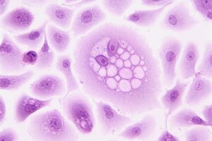 Neoplasia maligna y neoplasia benigna, ¿qué significan?. Foto por National Cancer Institute. Pixabay.