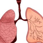 Diagnóstico y tratamiento de Edema Pulmonar