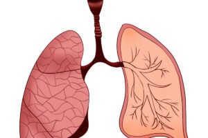 Diagnóstico y tratamiento de Edema Pulmonar