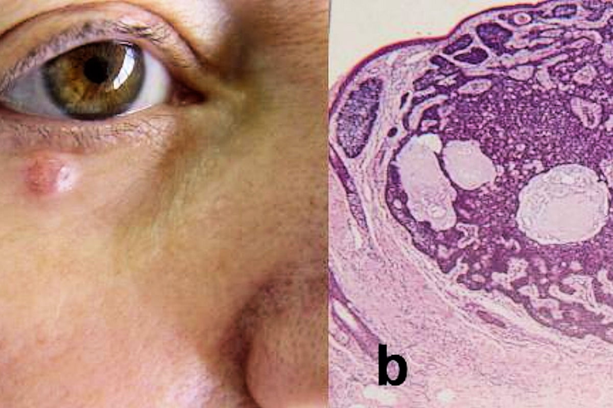 Neoplasma