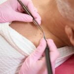 Female hands of dermatologist remove neoplasms using radio wave scalpel