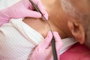 Female hands of dermatologist remove neoplasms using radio wave scalpel