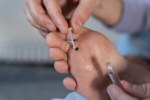 Usos Médicos del Ácido Fórmico » Verrugas, Varroa y Antibiótico. Foto por Envato.