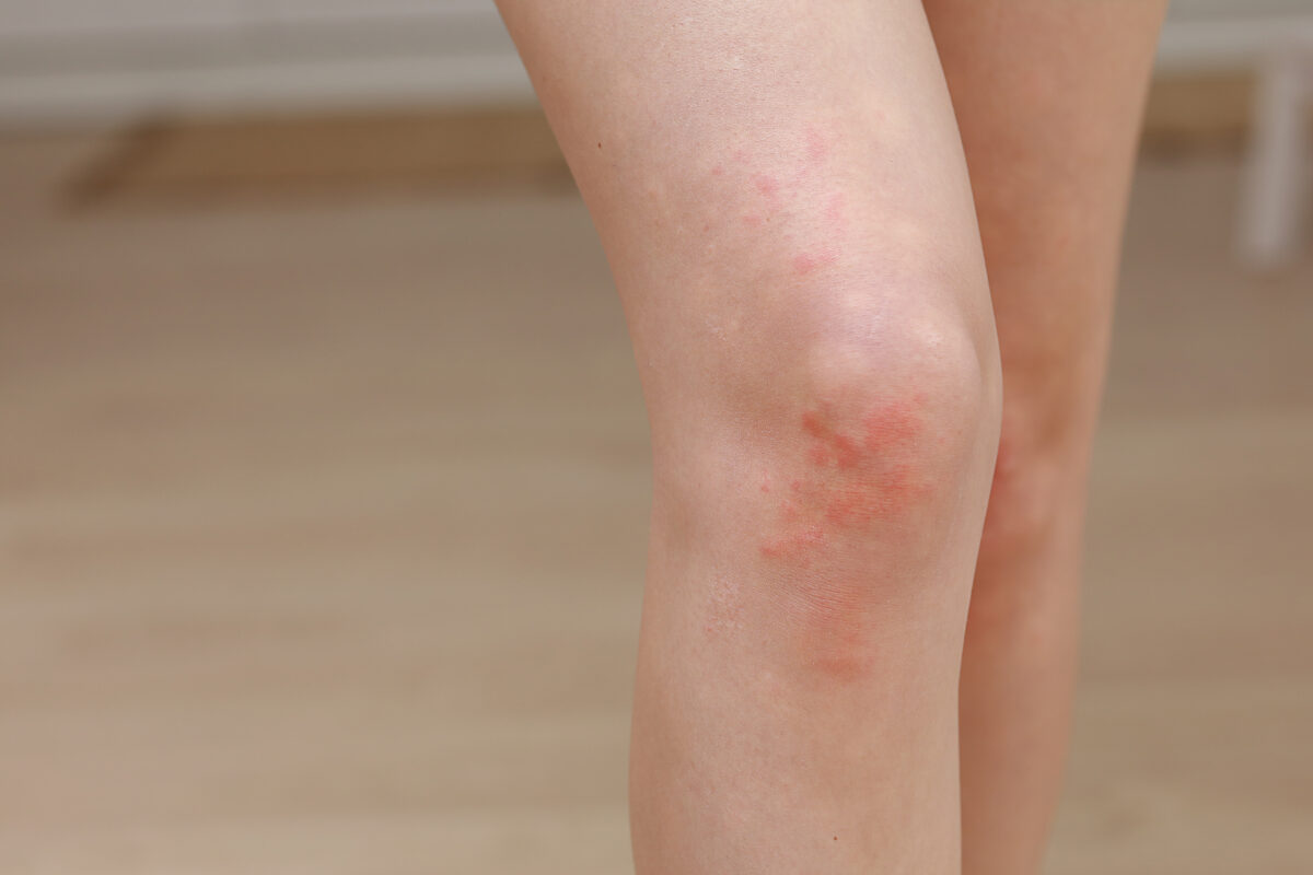 Remedios ante picaduras de carcoma. Foto por Envato.