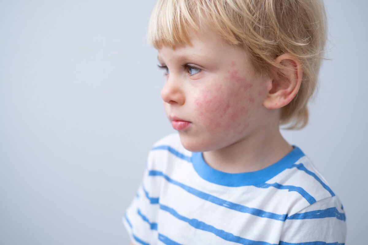 portrait of little boy with allergic rash or eczema on face. severe allergic reaction, atopic skin