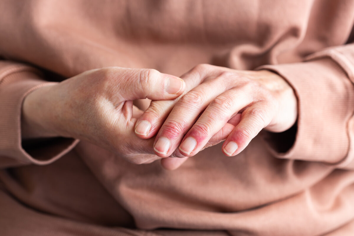 Woman hands with atopic dermatitis, eczema, allergy reaction on skin